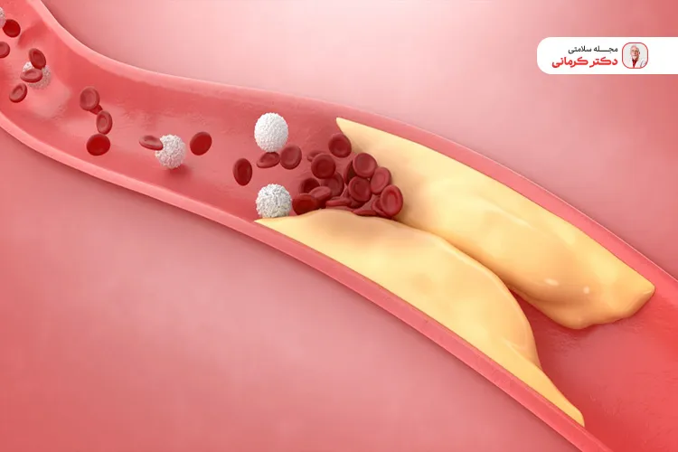 قرص فنوفیبرات برای کنترل چربی خون است.