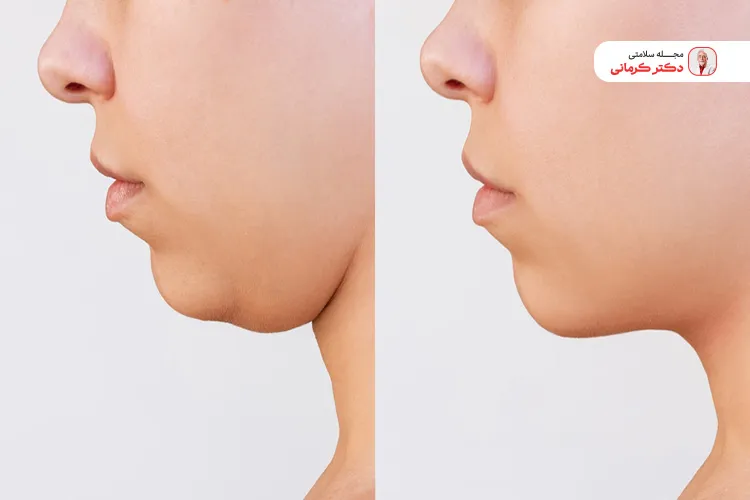 عمل لاغری صورت؛ توصیه میشود؟ face slimming 3 عمل لاغری صورت یک روش موضعی و موقتی است.