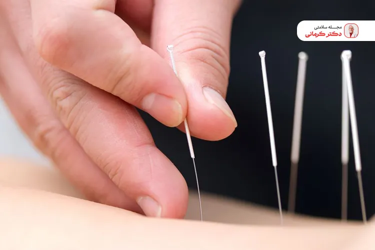 لاغری با امبدینگ شاخه ای از طب سوزنی آسیای شرقی است.